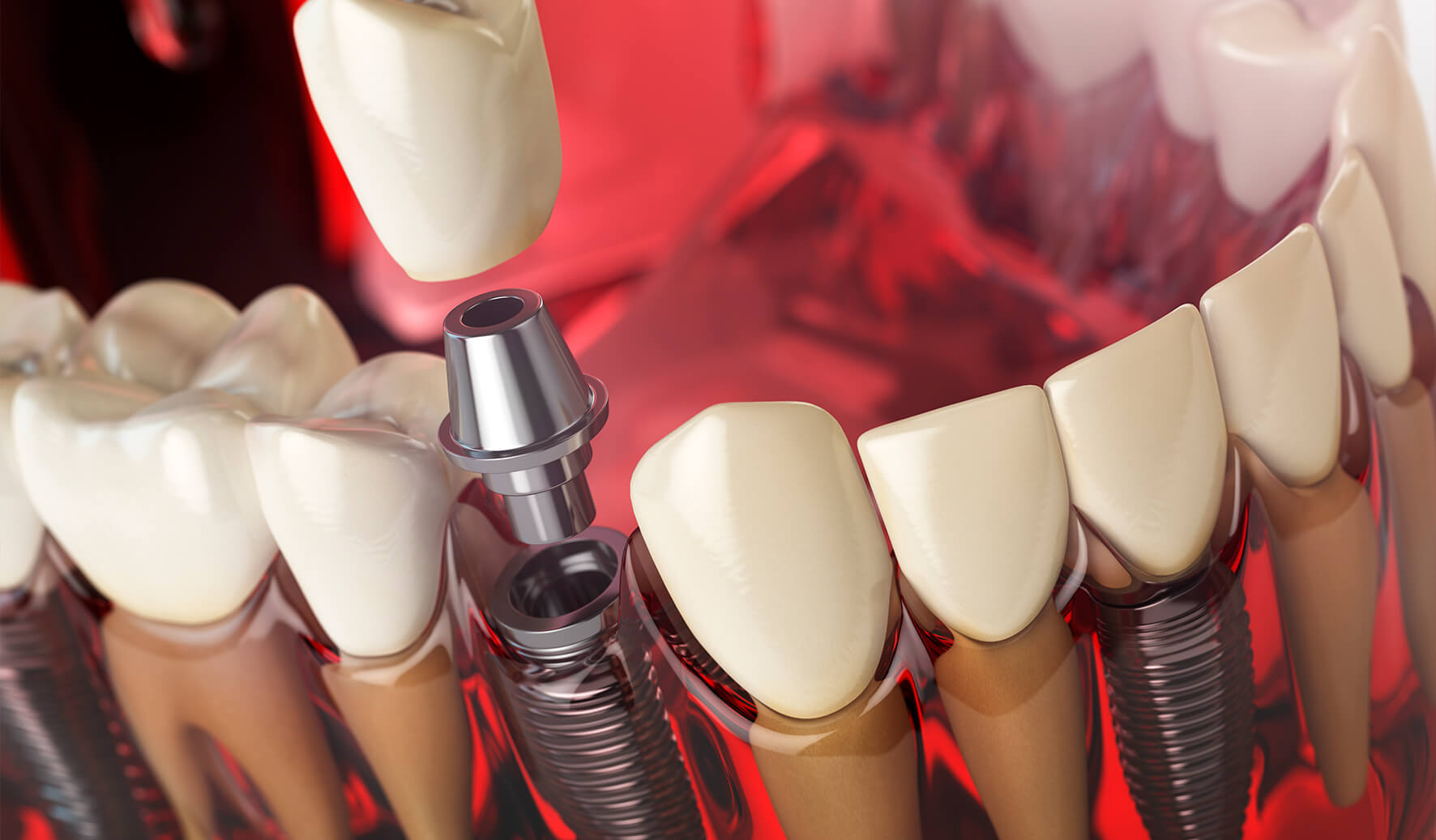 implante dentário